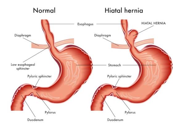 Graphic showing a hiatus hernia.