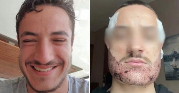 Mathieu Vigier Latour took his life after a botched beard operation in Turkey