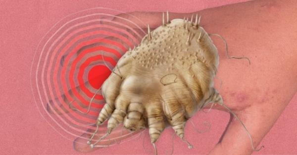 A composite images show a scabites mite against an itchy hand.